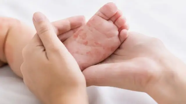 Kanadada 27 yil ichida ilk bor qizamiq epidemiyasi aniqlandi